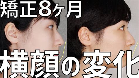 eライン 口元引っ込める 自力|矯正歯科で治せるイーラインと治療方法とは？歯科で美しい口元 .